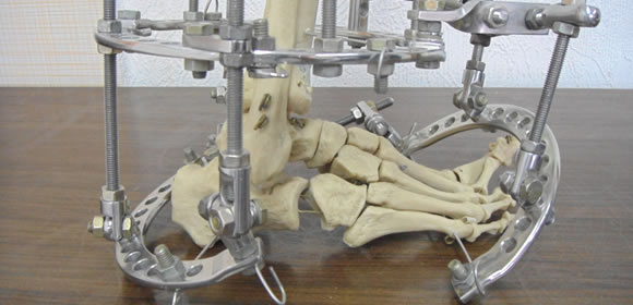 Correcting Complex Foot and Ankle Deformities