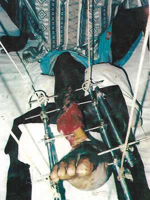 Ilizarov technology in Nigeria