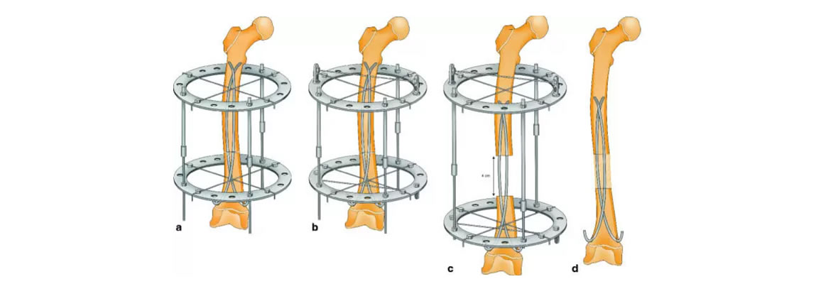Growing New Bones and Lengthening Short Limbs - Hopeville Specialist Hospital