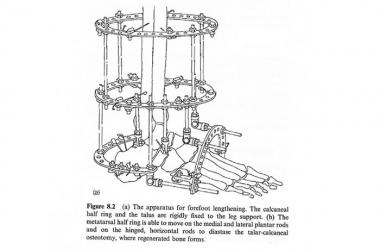 Correcting Complex Foot and Ankle Deformities - Hopeville Specialist Hospital