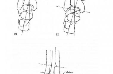 Correcting Axial Deviations of the Tibial Pilon - Hopeville Specialist Hospital