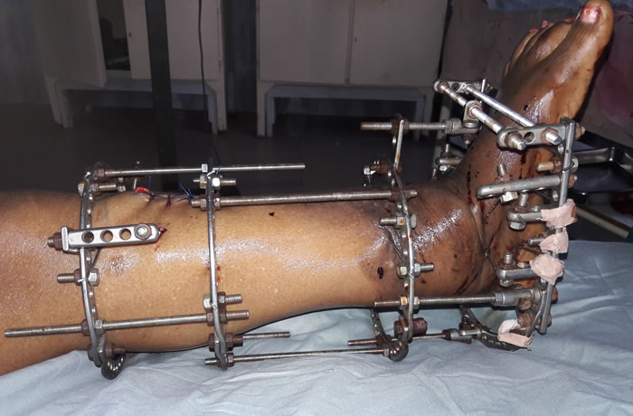 The Challenge of Orthopedic and Trauma Practice in Nigeria - Hopeville Specialist Hospital