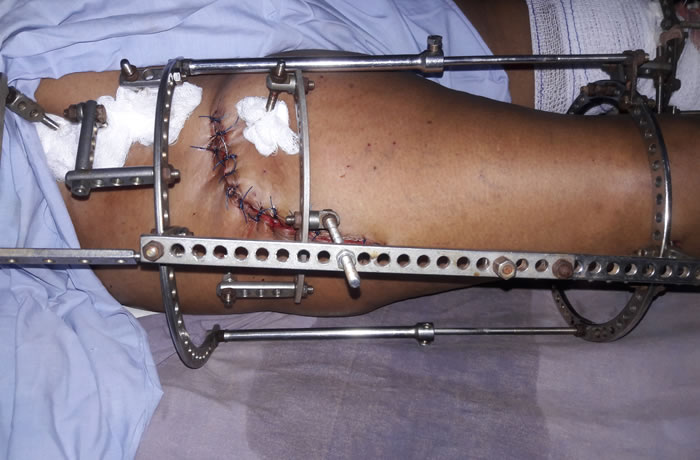 The Challenge of Orthopedic and Trauma Practice in Nigeria - Hopeville Specialist Hospital