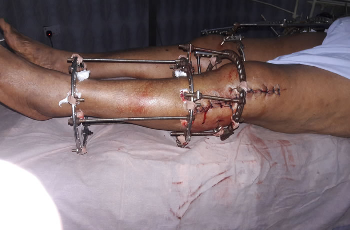 The Challenge of Orthopedic and Trauma Practice in Nigeria - Hopeville Specialist Hospital